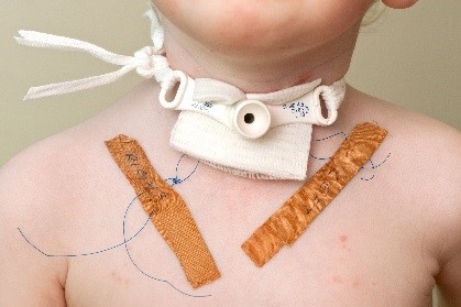 post op management post op management